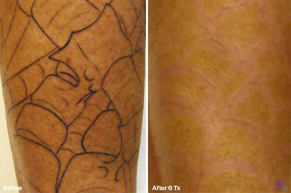 Before and after tattoo removal